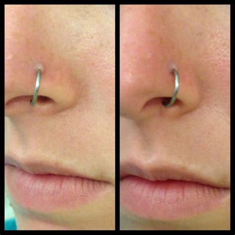 keloid nose piercing|nose piercing irritation inside.